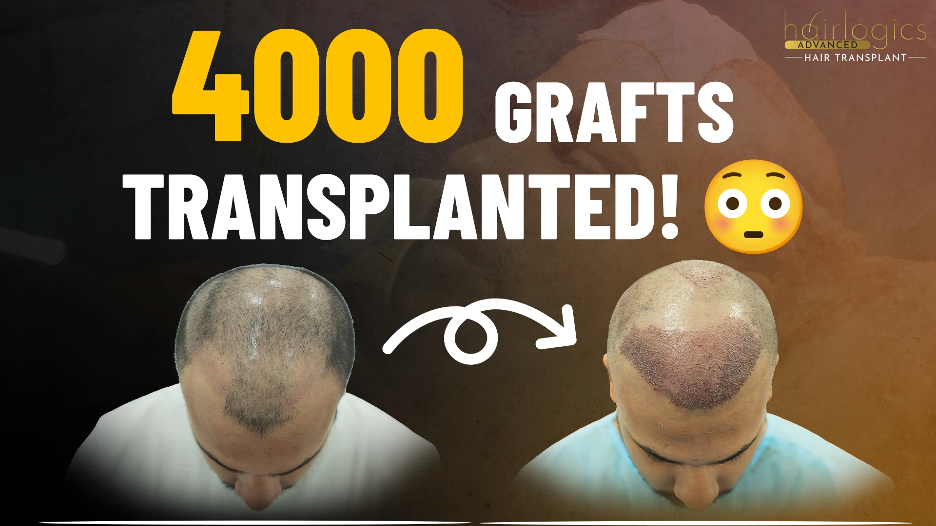 hair transplant before and after