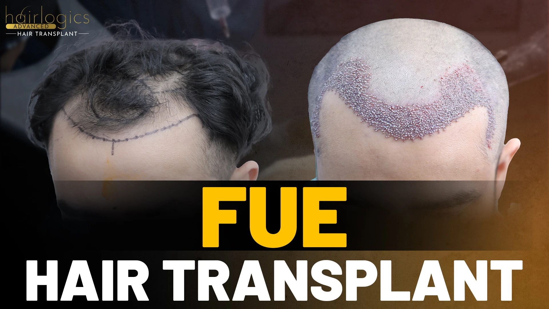 hair transplant before and after